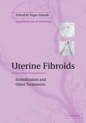 Uterine Fibroids